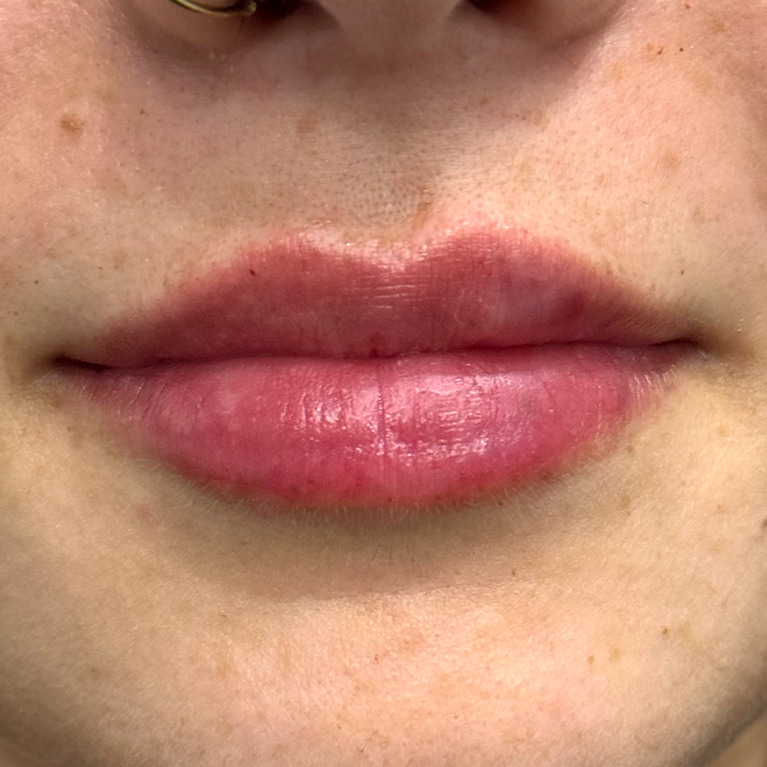 Lip filler transformation in Metairie | Metairie Lip Filler | Chronos BHW