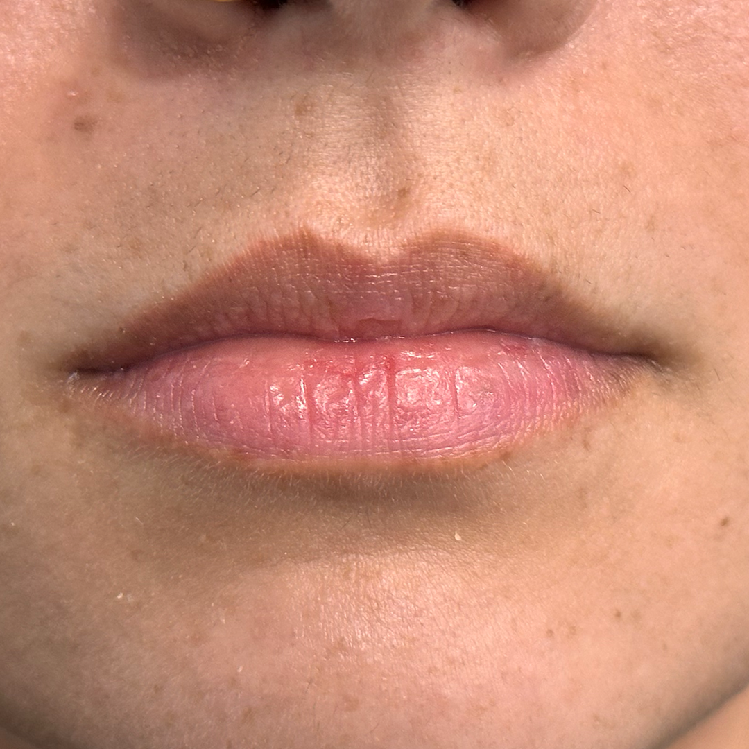 Lip filler in Metairie | Chronos BHW | Metairie Injector
