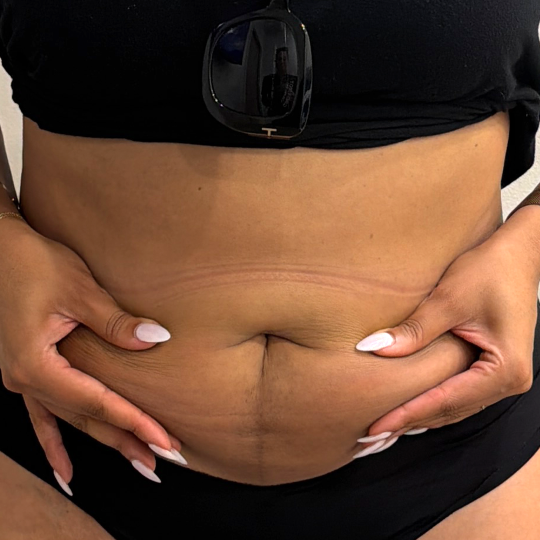 Shrink fat with CoolSculpting Elite | Chronos fat shrinking treatment | Metairie