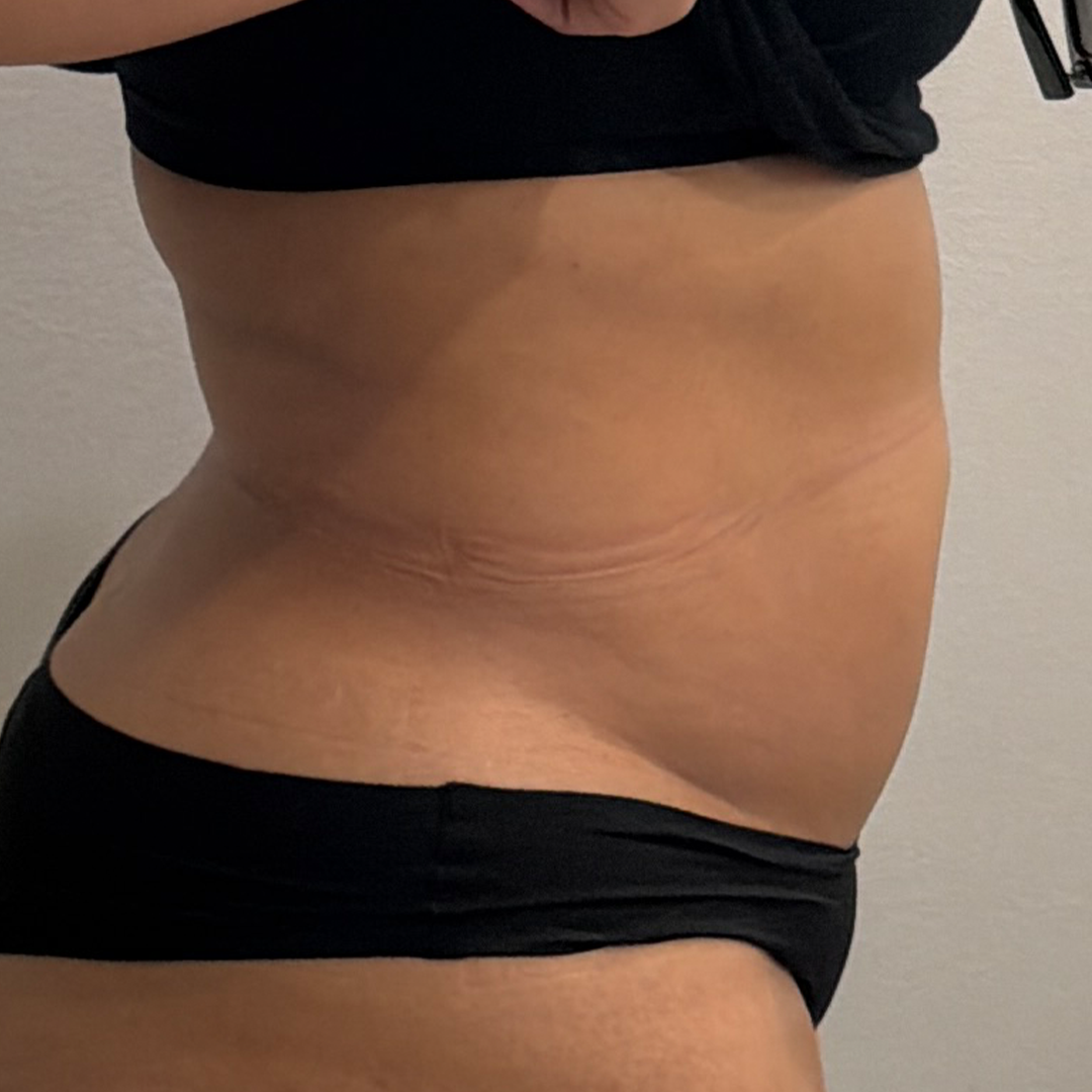 After CoolSculpting in Metairie, LA at Chronos BHW | CoolSculpting Elite results | Back Flanks