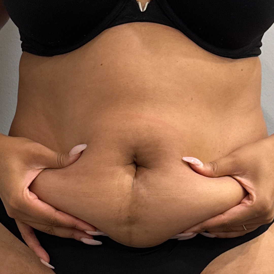 CoolSculpting transformation photos | Body contouring in Metairie | Chronos