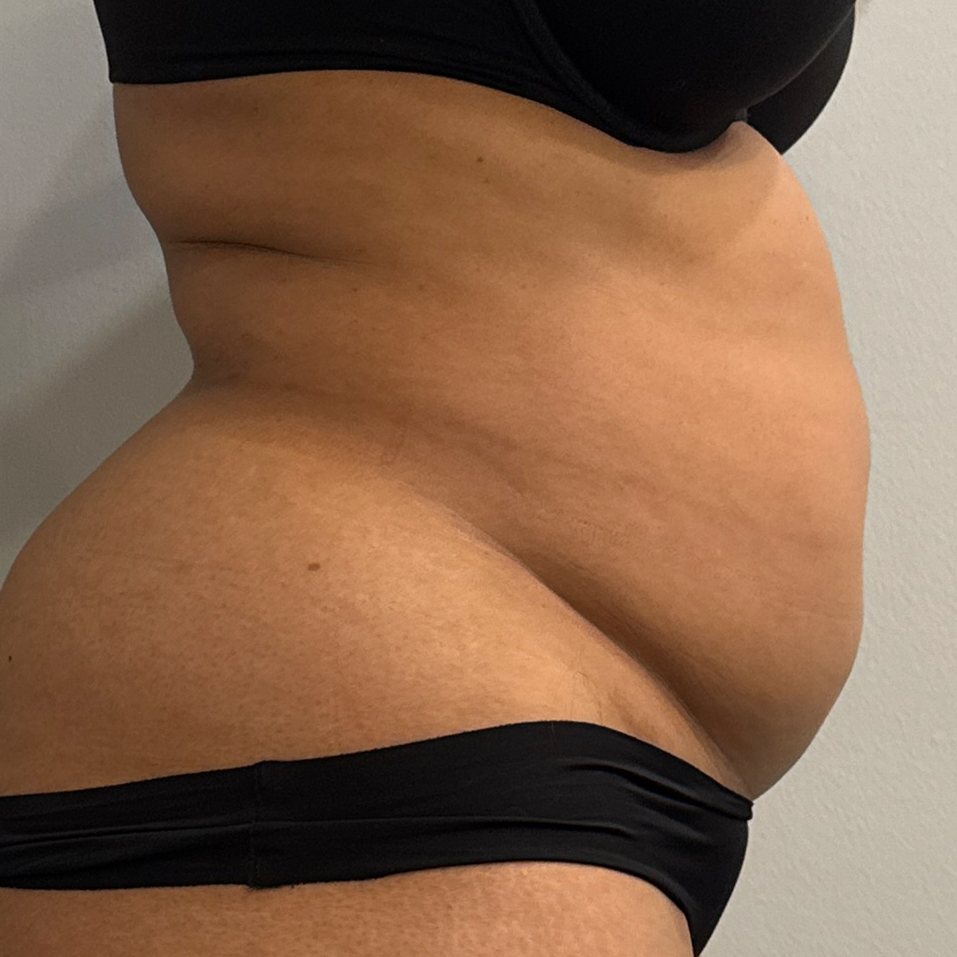 Before CoolSculpting Elite in Metairie, LA at Chronos BHW | Back flank treatments