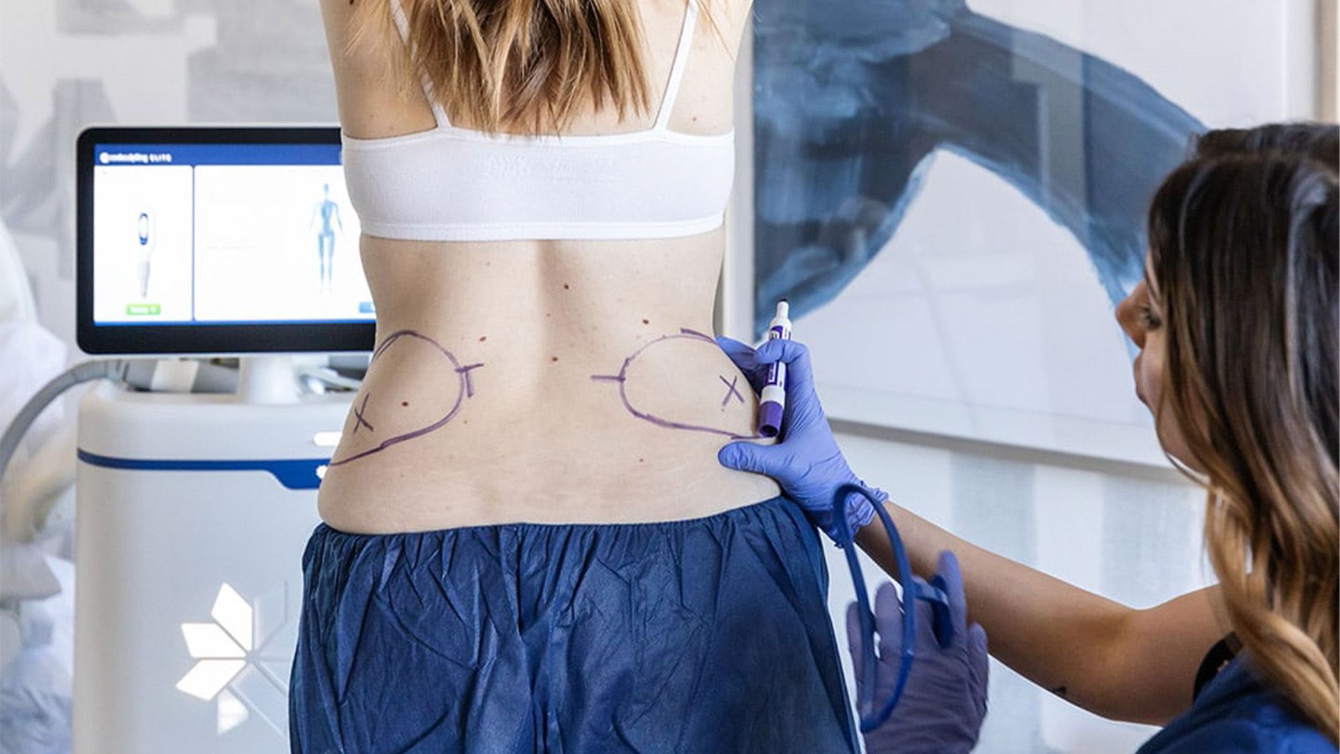 CoolSculpting Elite fat reduction treatment in Metairie | Chronos BHW