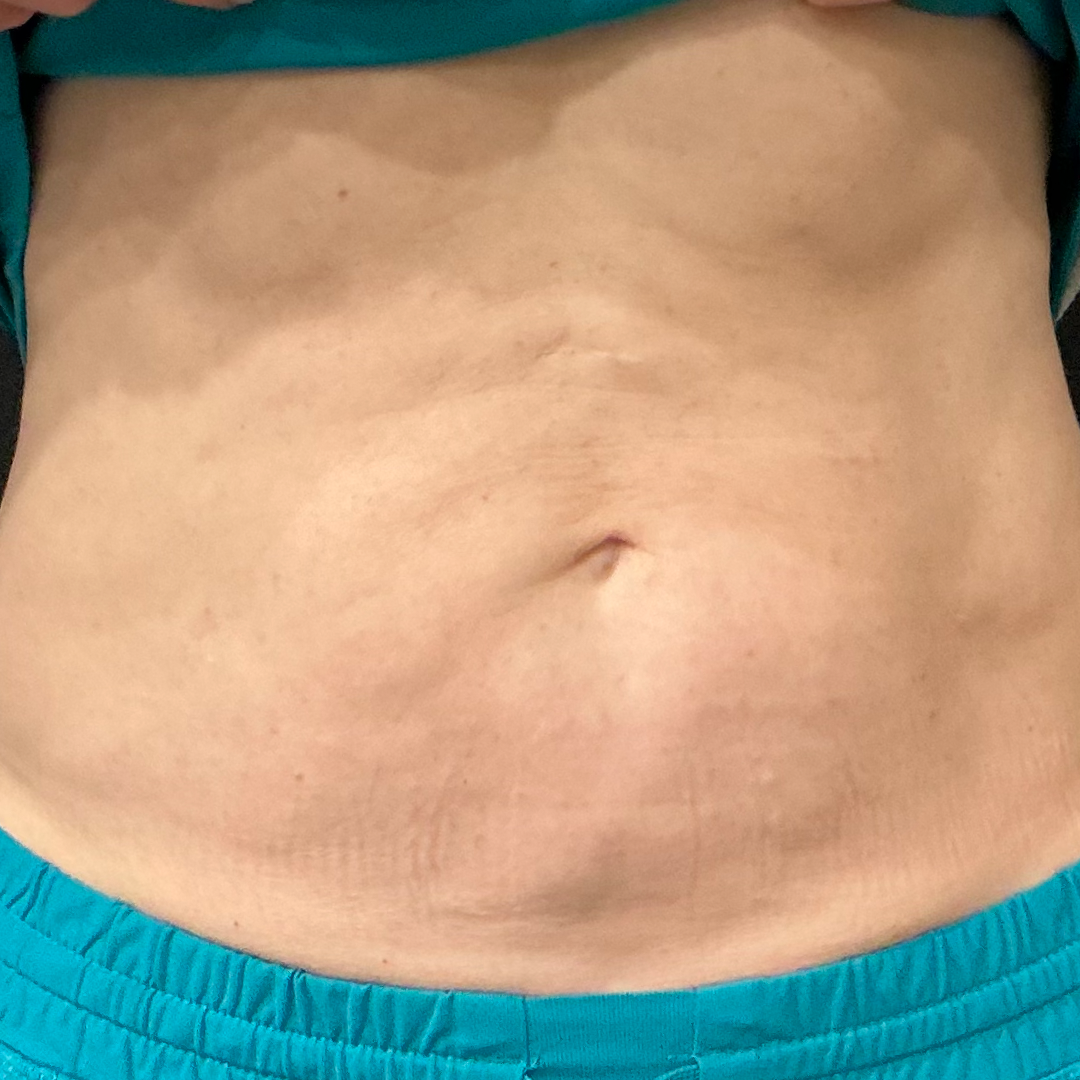 CoolSculpting transformation in Metairie, LA at Chronos BHW | Fat loss treatment