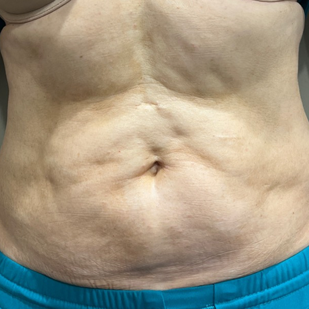 Before photos of CoolSculpting Elite in Metairie, LA at Chronos BHW | Fat reduction