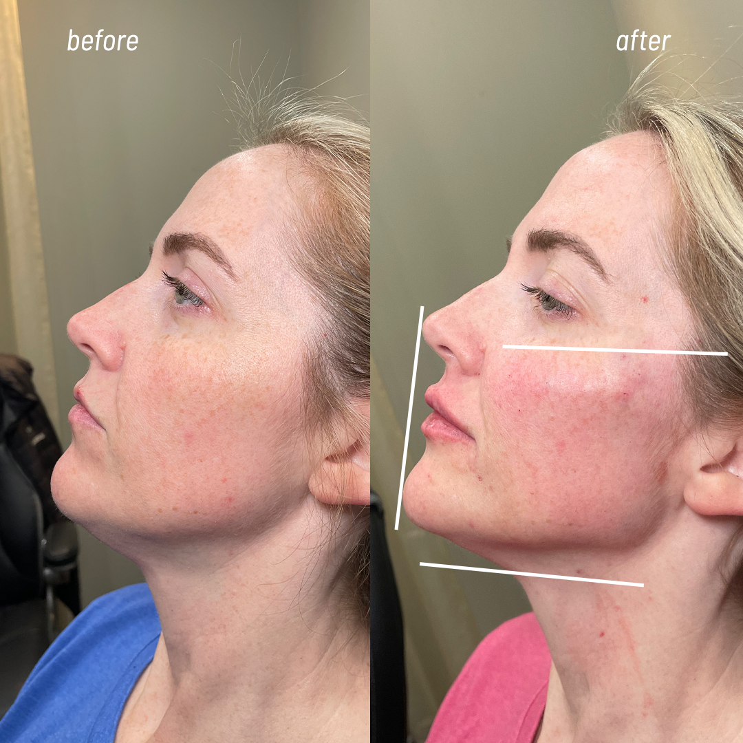 Facial balancing filler | Natural Filler in Metairie and New Orleans | Chronos BHW
