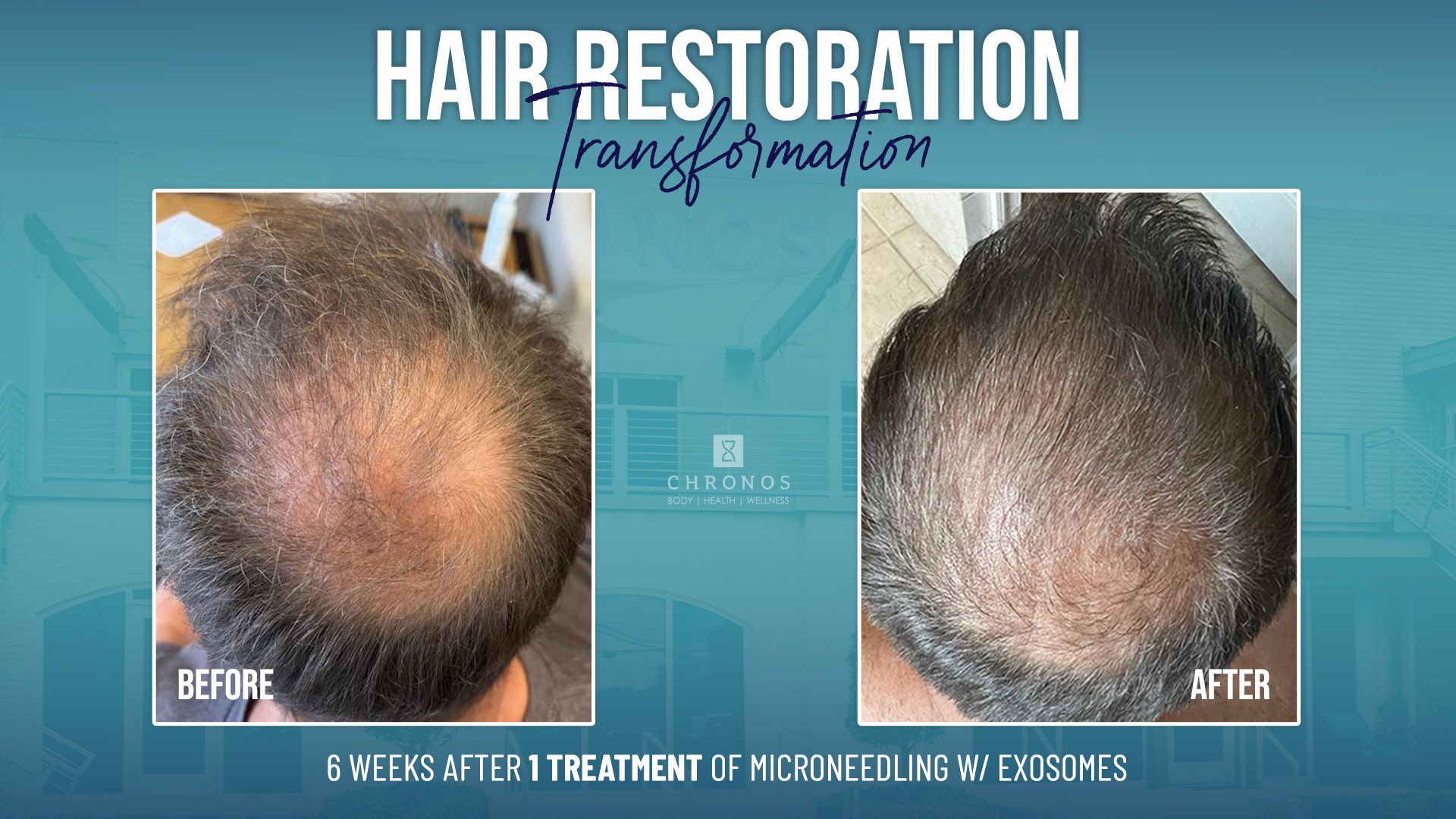 Hair loss treatments in metairie, LA | Chronos BHW