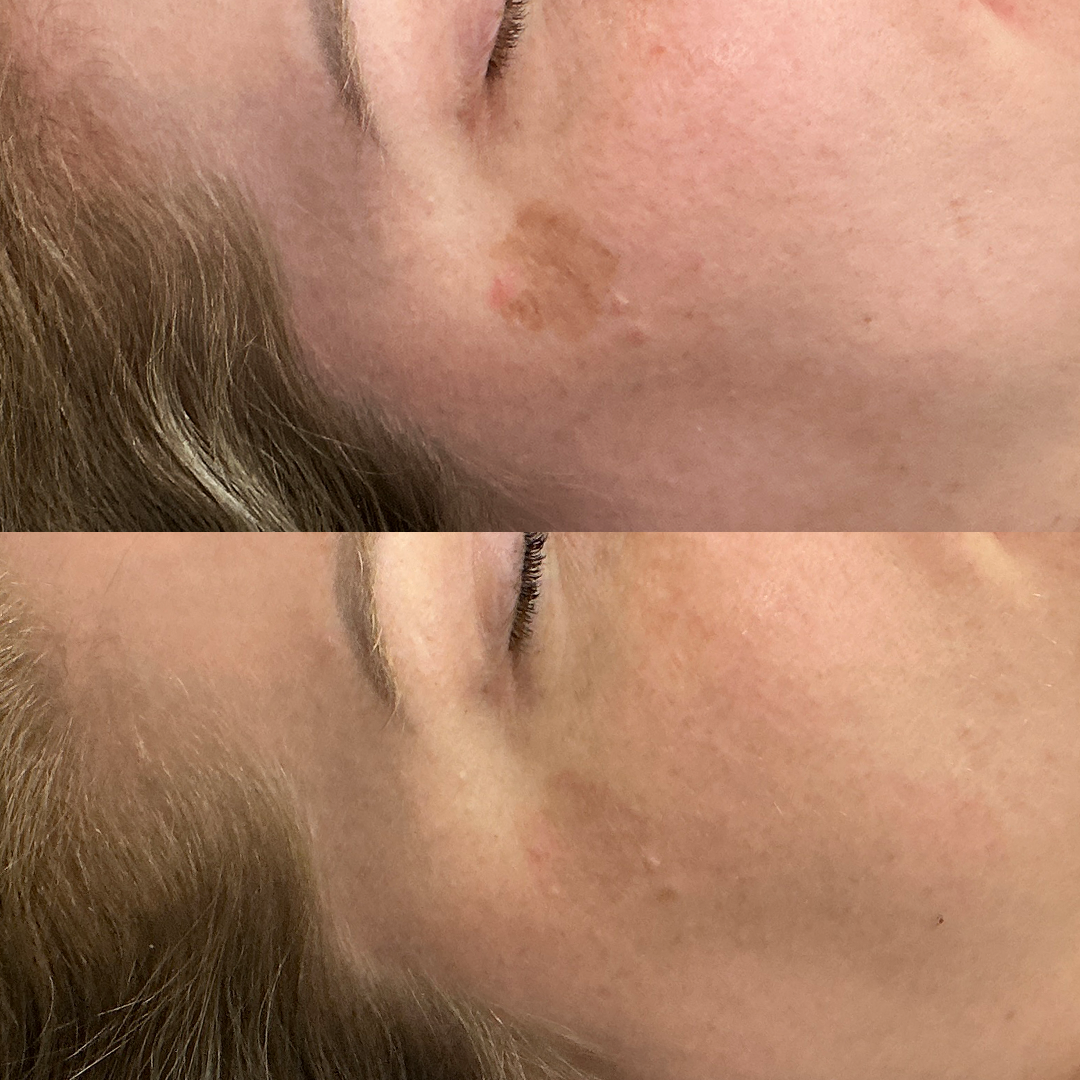 IPL Photofacial results | IPL Metairie | Chronos BHW