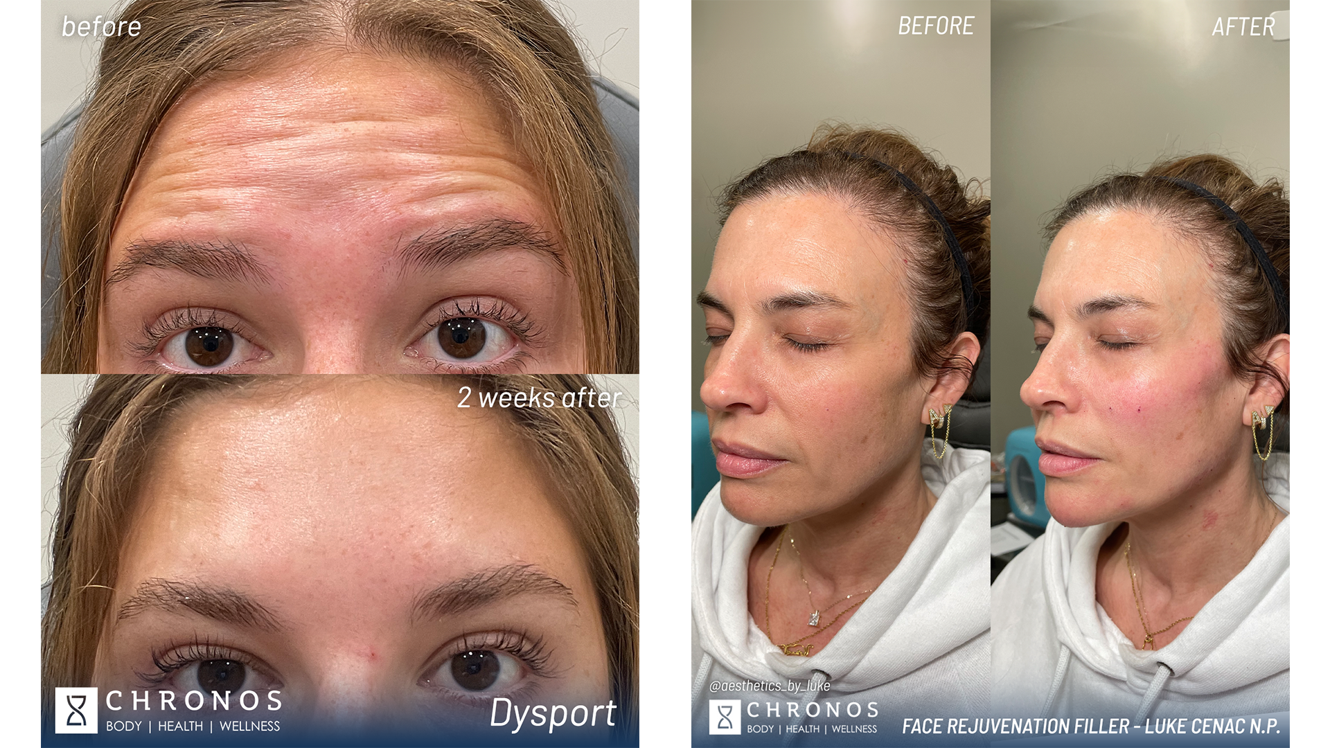 Injectables in Metairie | Aesthetic injector at Chronos BHW | Botox and filler