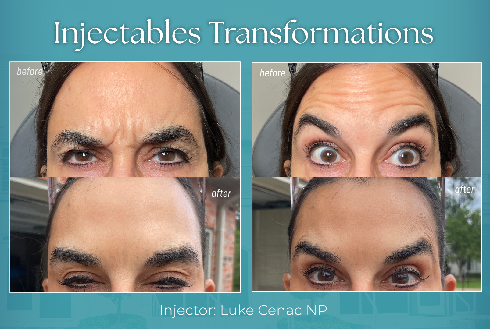 Botox near me in Metairie, LA | Dysport injections | Chronos BHW