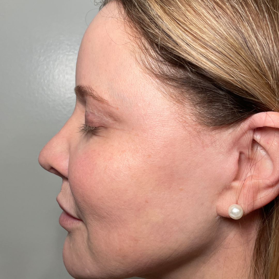 Moxi & BBL stacked laser treatment results in Metairie, LA | Chronos BHW