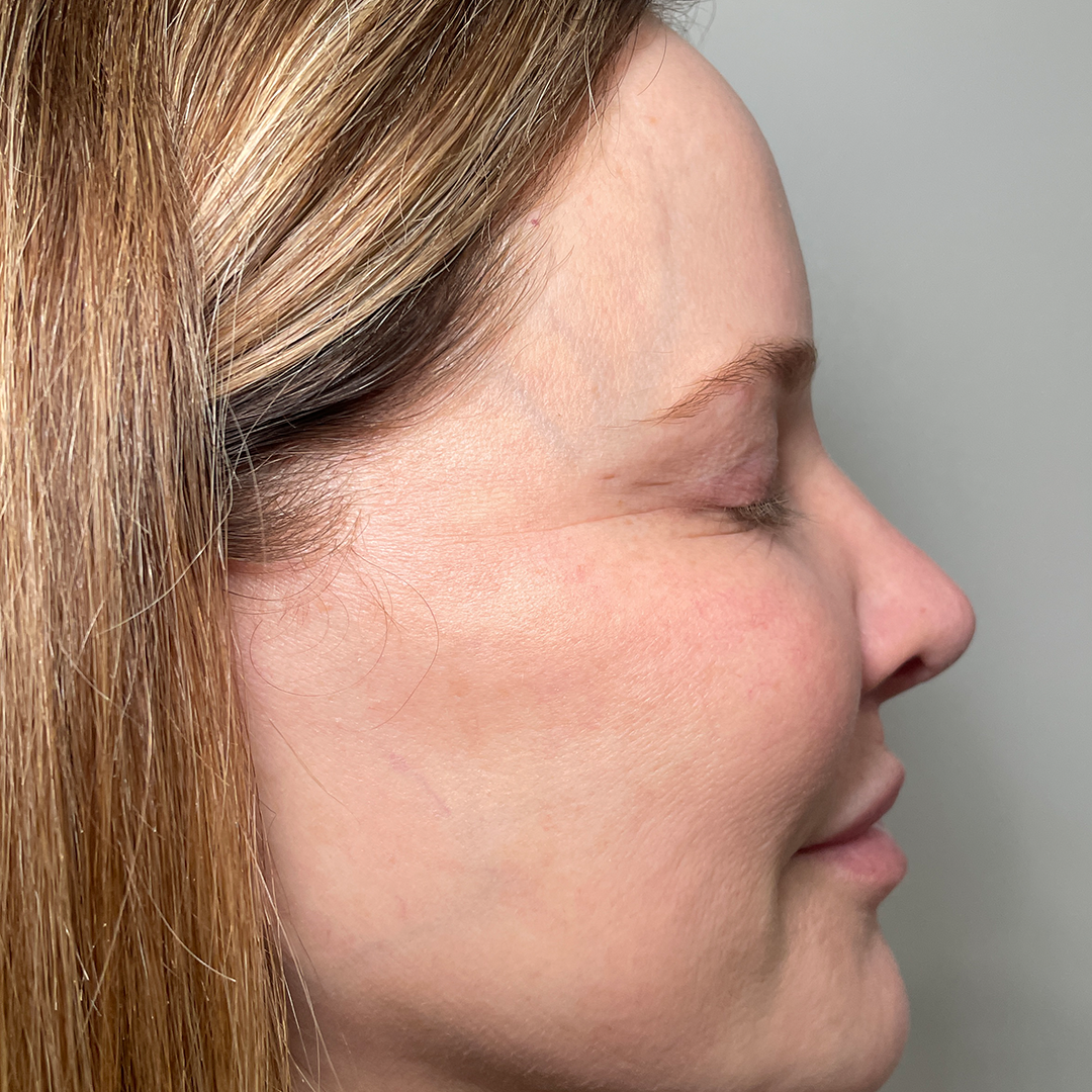 after Moxi laser facial in Metairie | Chronos med spa laser resurfacing