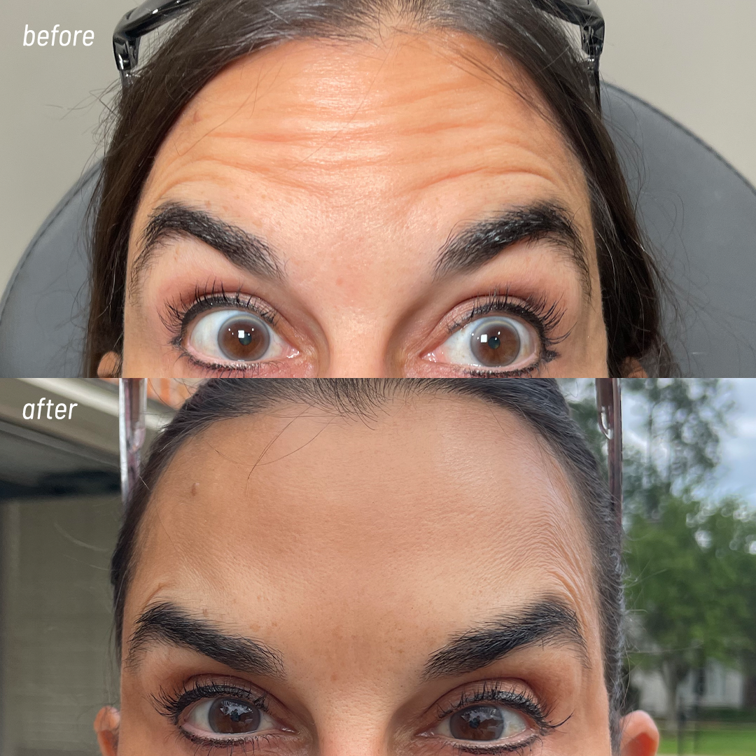 Dysport injections near me | Botox anti-aging injection | Metairie | Chronos