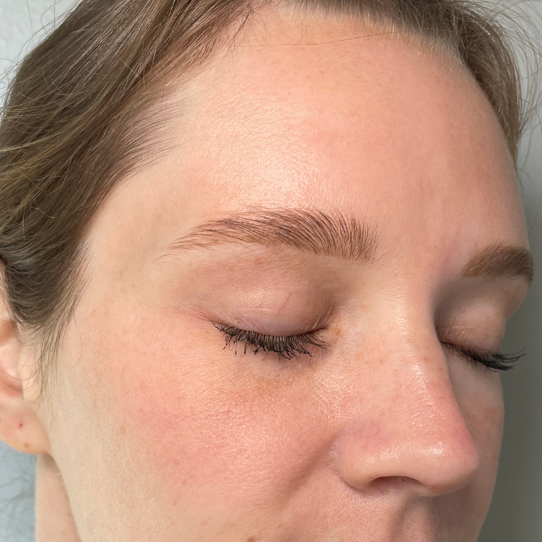 Moxi Laser results in Metairie, LA | Chronos BHW