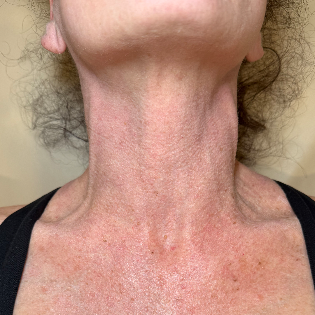 Moxi & BBL stacked laser treatment results in Metairie, LA | Chronos BHW