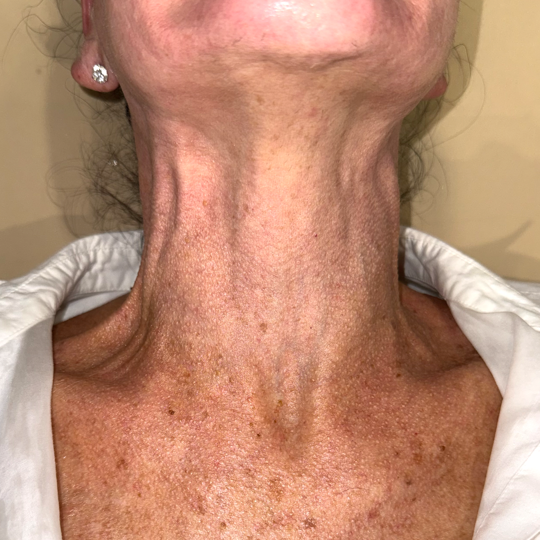 Moxi & BBL Treatments in Metairie | Chronos BHW | Sciton Laser treatments