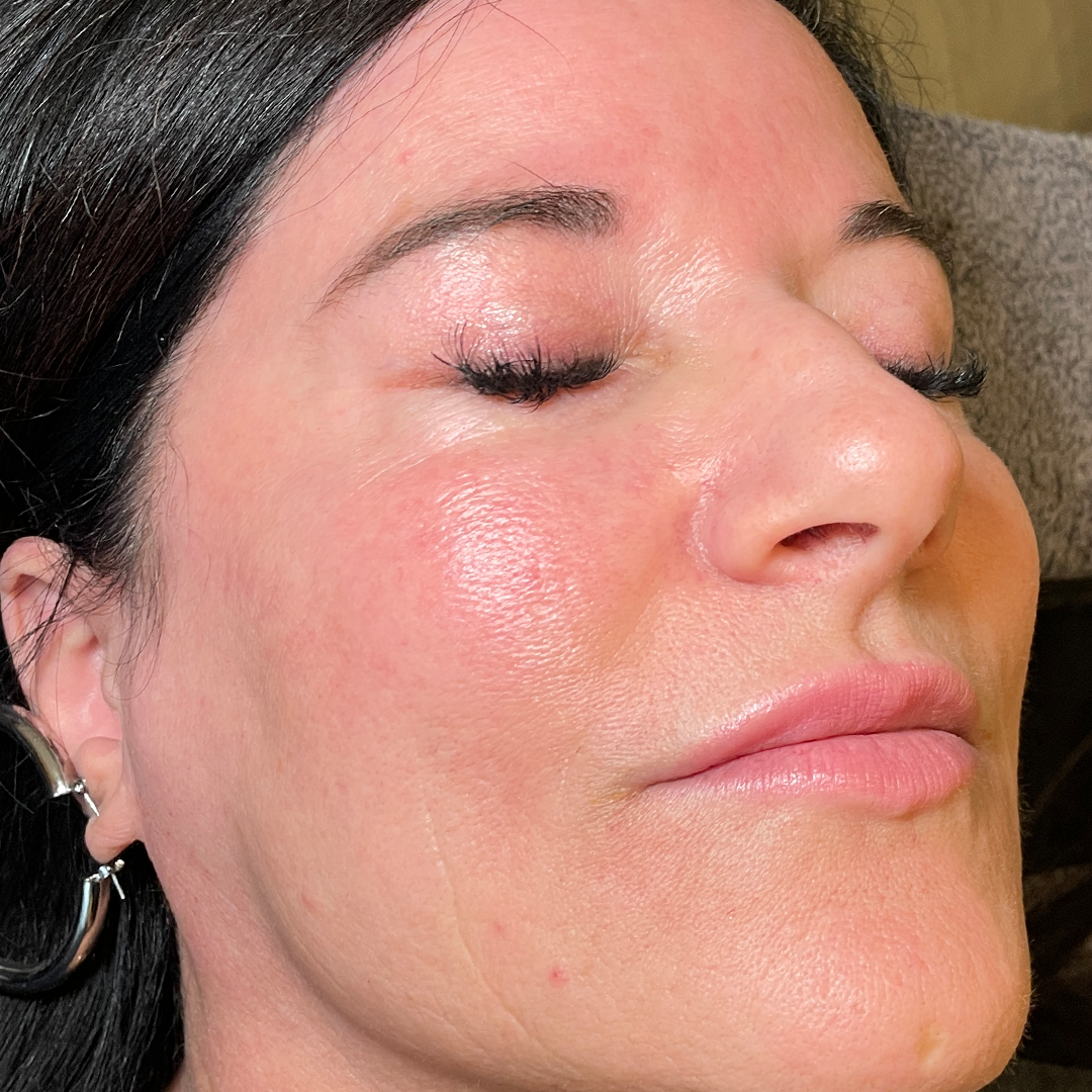 BBL HEROic and MOXI laser transformation | Laser resurfacing in Metairie | Chronos BHW