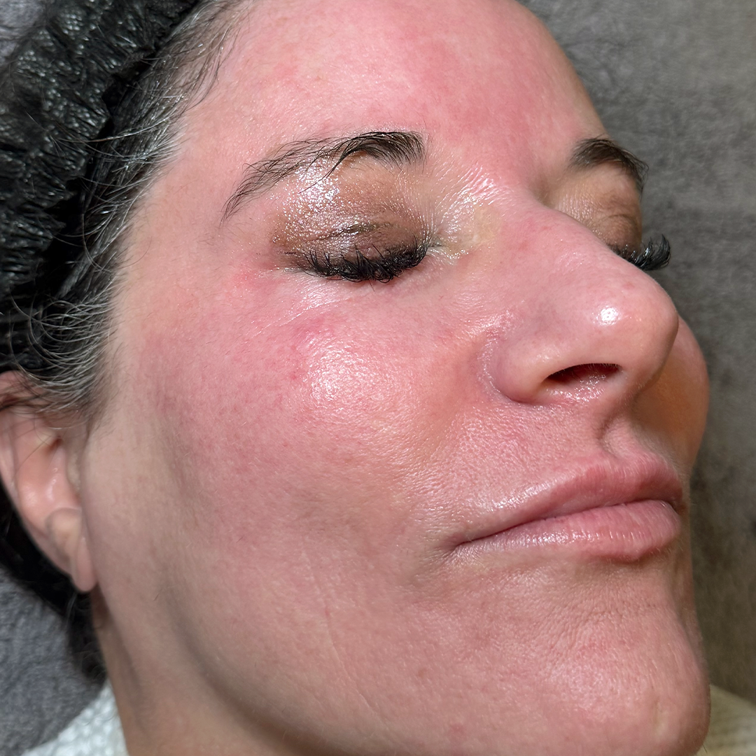 BBL and Moxi laser treatment tranformation | Chronos BHW in Metairie Lasers