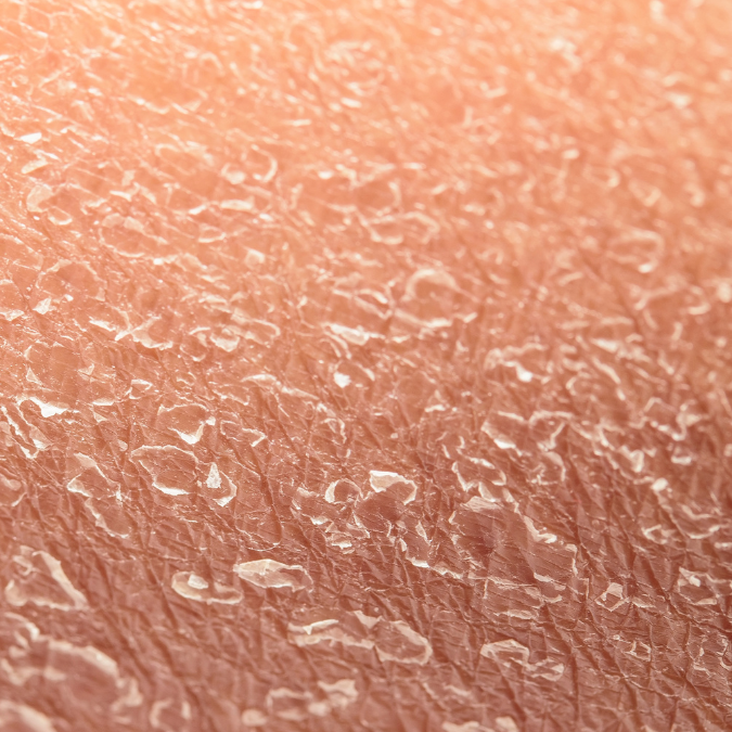 Dry flaky skin treatment in Metairie | Skin treatment | Facials