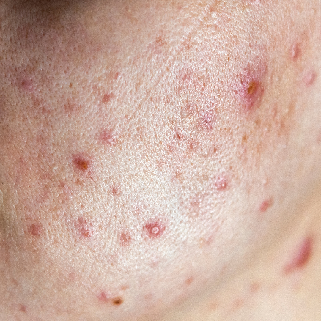 Acne facial in Metairie | Acnes treatments near me | Chronos BHW