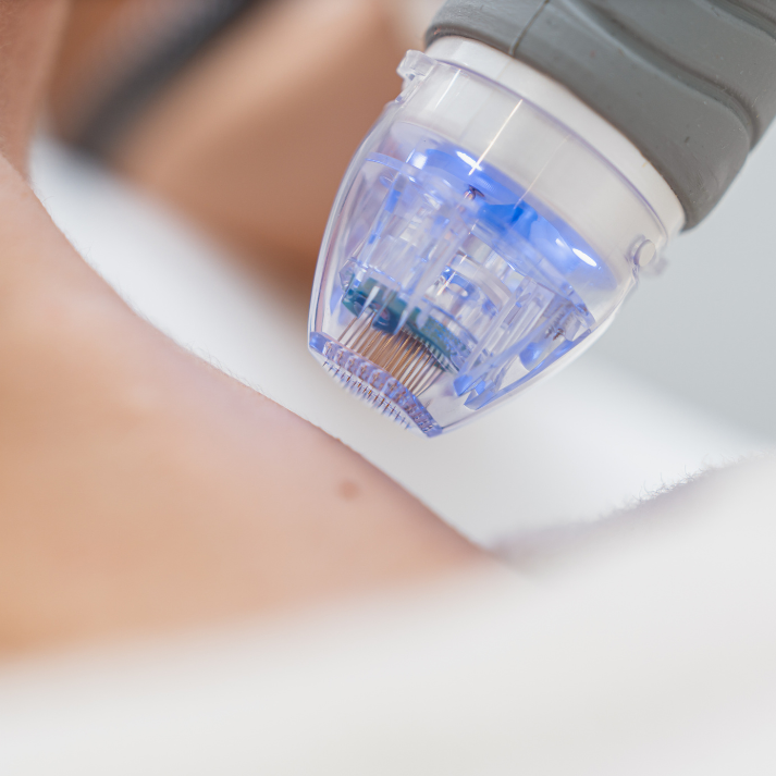 Microneedling for treating cne and acne scarring | Chronos BHW in Metairie