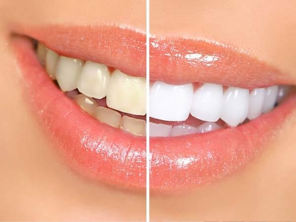 DRA BEATRIZ PALACIOS ZUÑIGA - Blanqueamiento dental