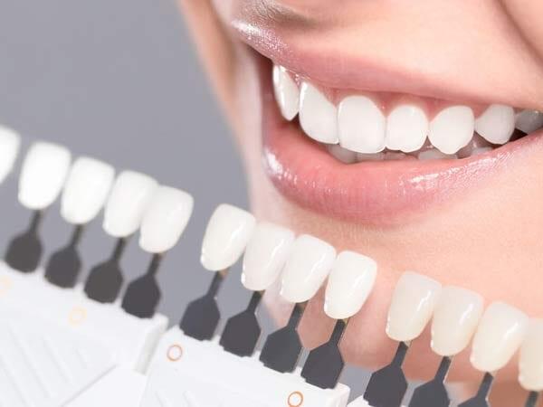 DRA BEATRIZ PALACIOS ZUÑIGA - Carillas dentales