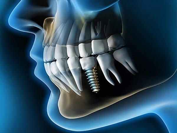 DRA BEATRIZ PALACIOS ZUÑIGA - Implantes dentales