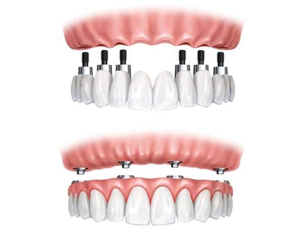 DRA BEATRIZ PALACIOS ZUÑIGA - Prótesis Dentales