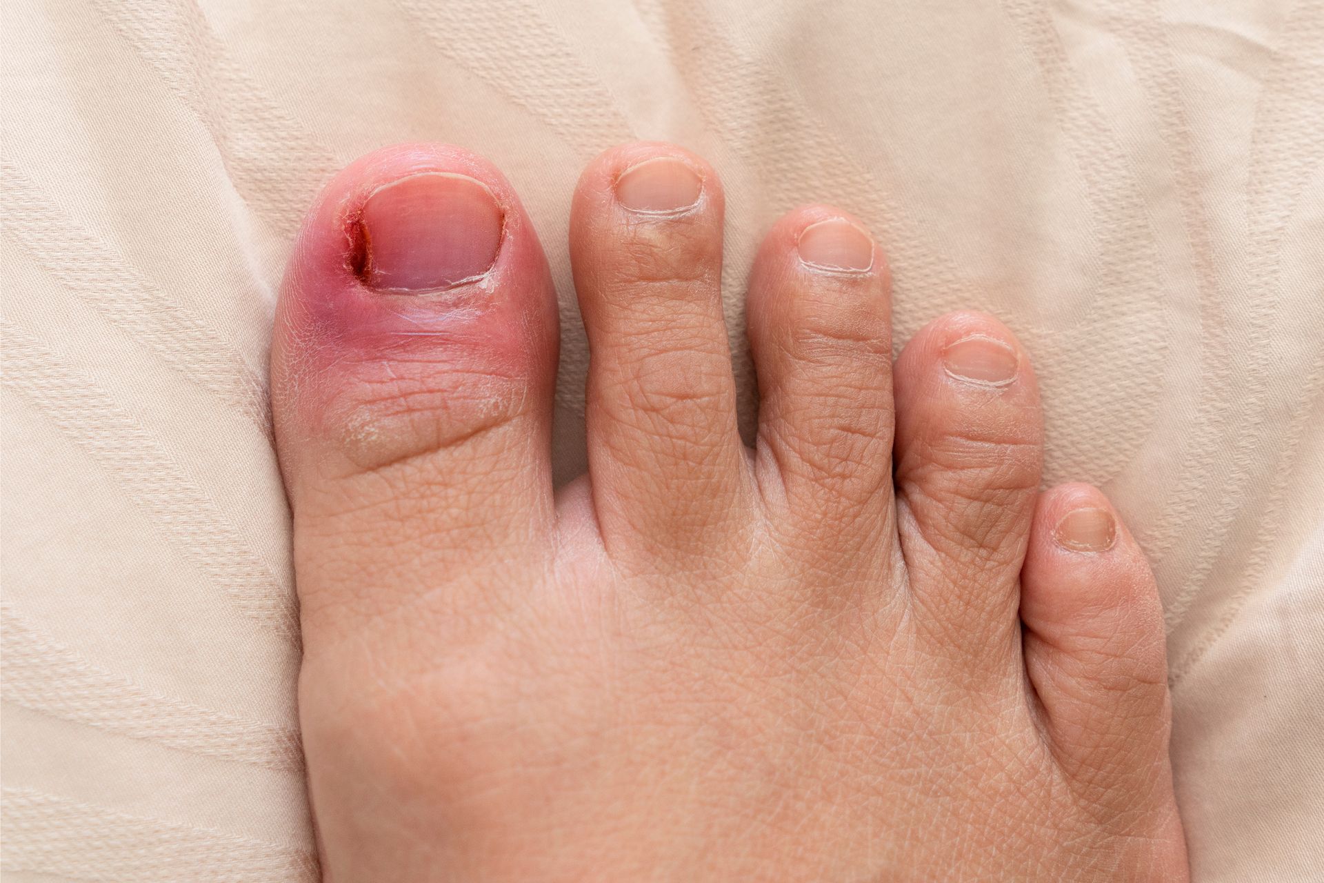 A swollen, infected big toe with red, inflamed skin and a damaged nail on a fabric background A swollen, infected big toe with red, inflamed skin and a damaged nail on a fabric background