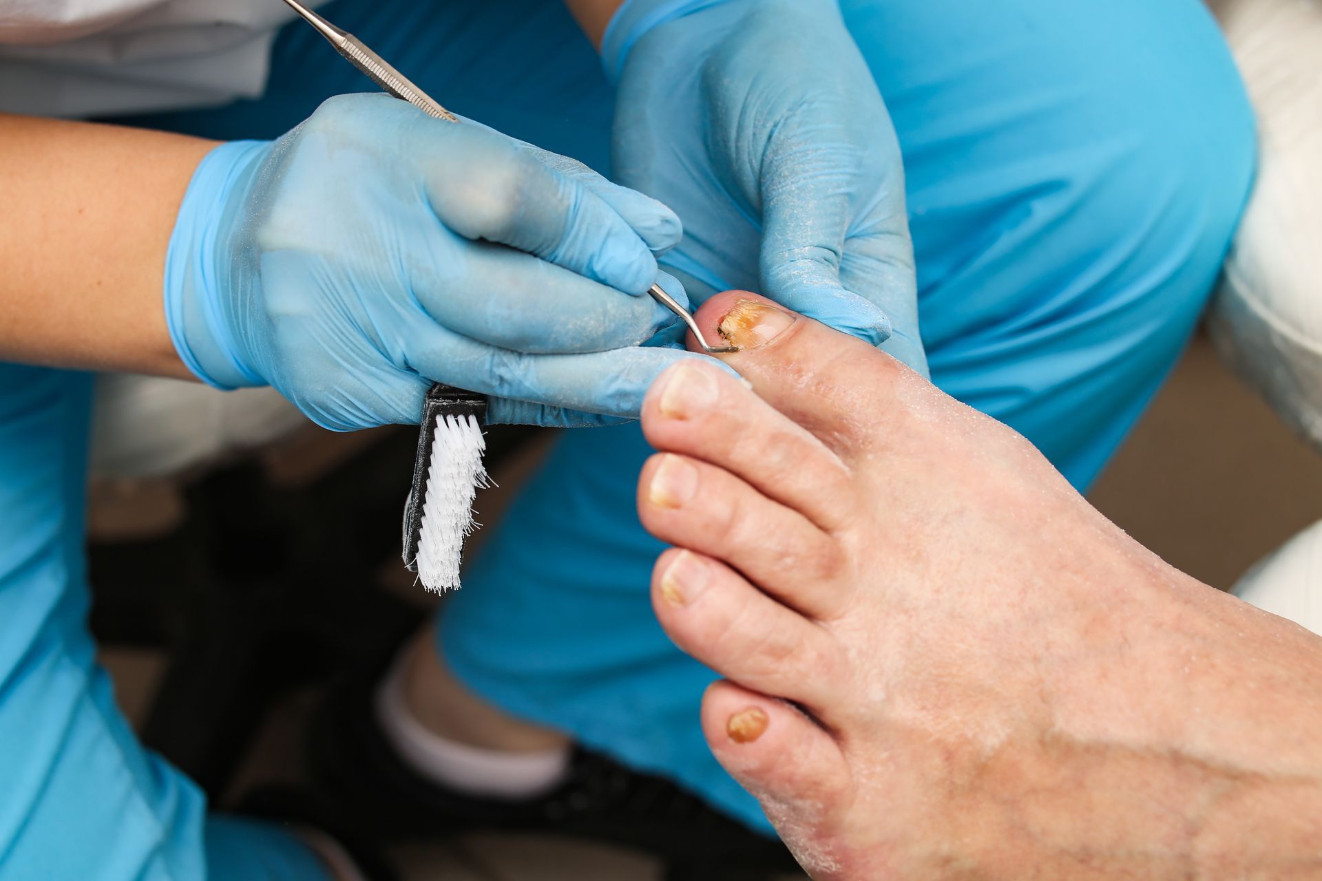 Gloved clinician using a metal instrument to perform ingrown toenails treatment on a patient's toe.