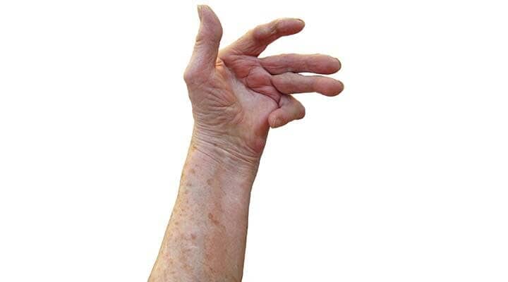 ​UNIDAD DE REUMATOLOGÍA DEL SURESTE - artritis reumatoide