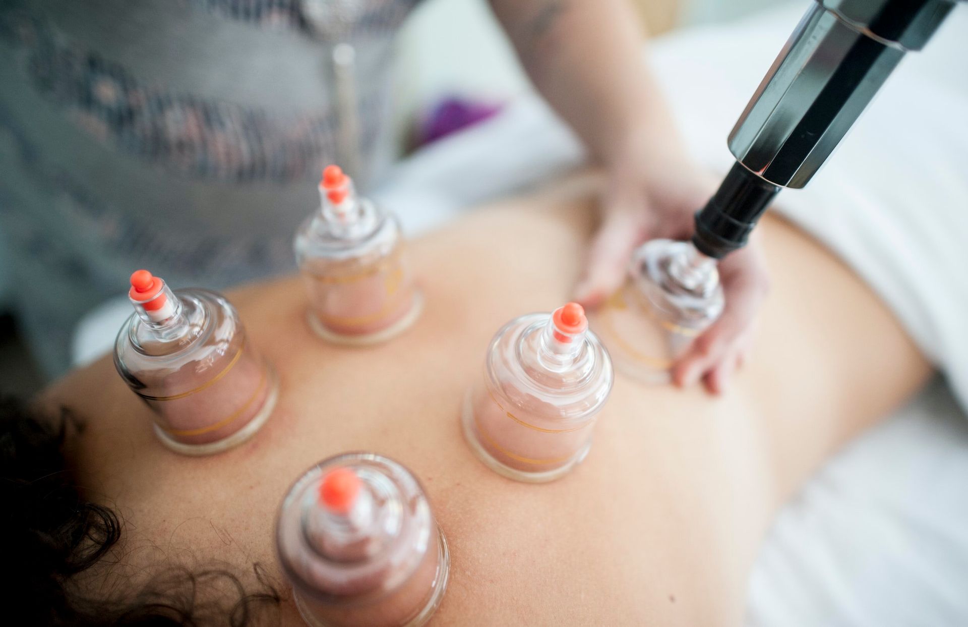 Cupping  in Franklin Lakes, NJ