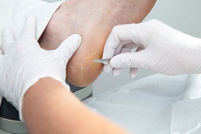 MANEJO AVANZADO DE ÚLCERAS Y PIE DIABÉTICO