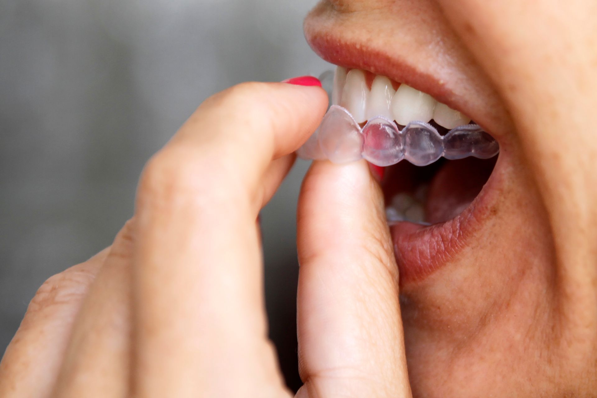 Close-up of woman wearing clear invisible orthodontics. Close-up of woman wearing clear invisible orthodontics.