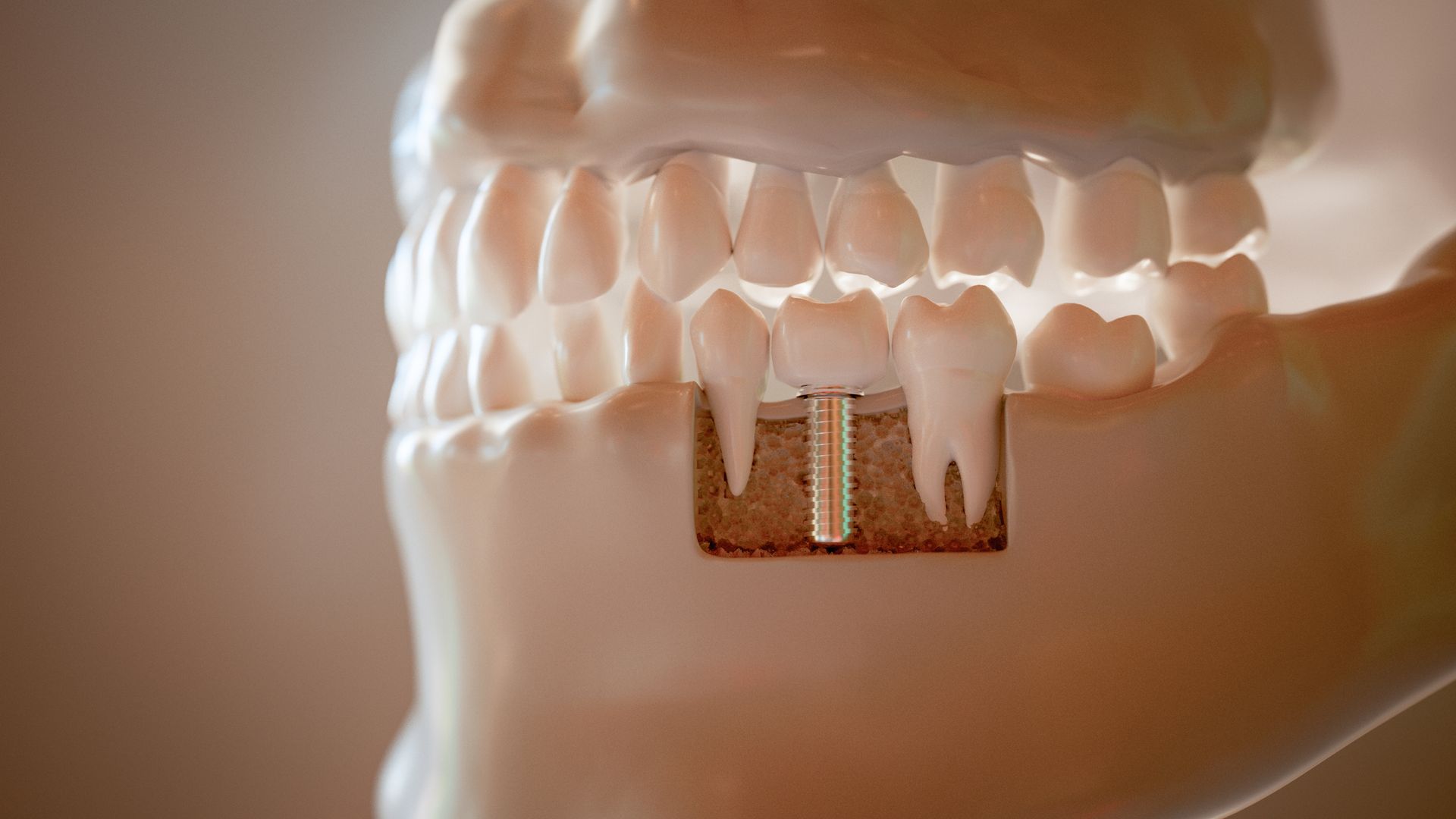 A close up of a model of a person 's teeth with a dental implant.