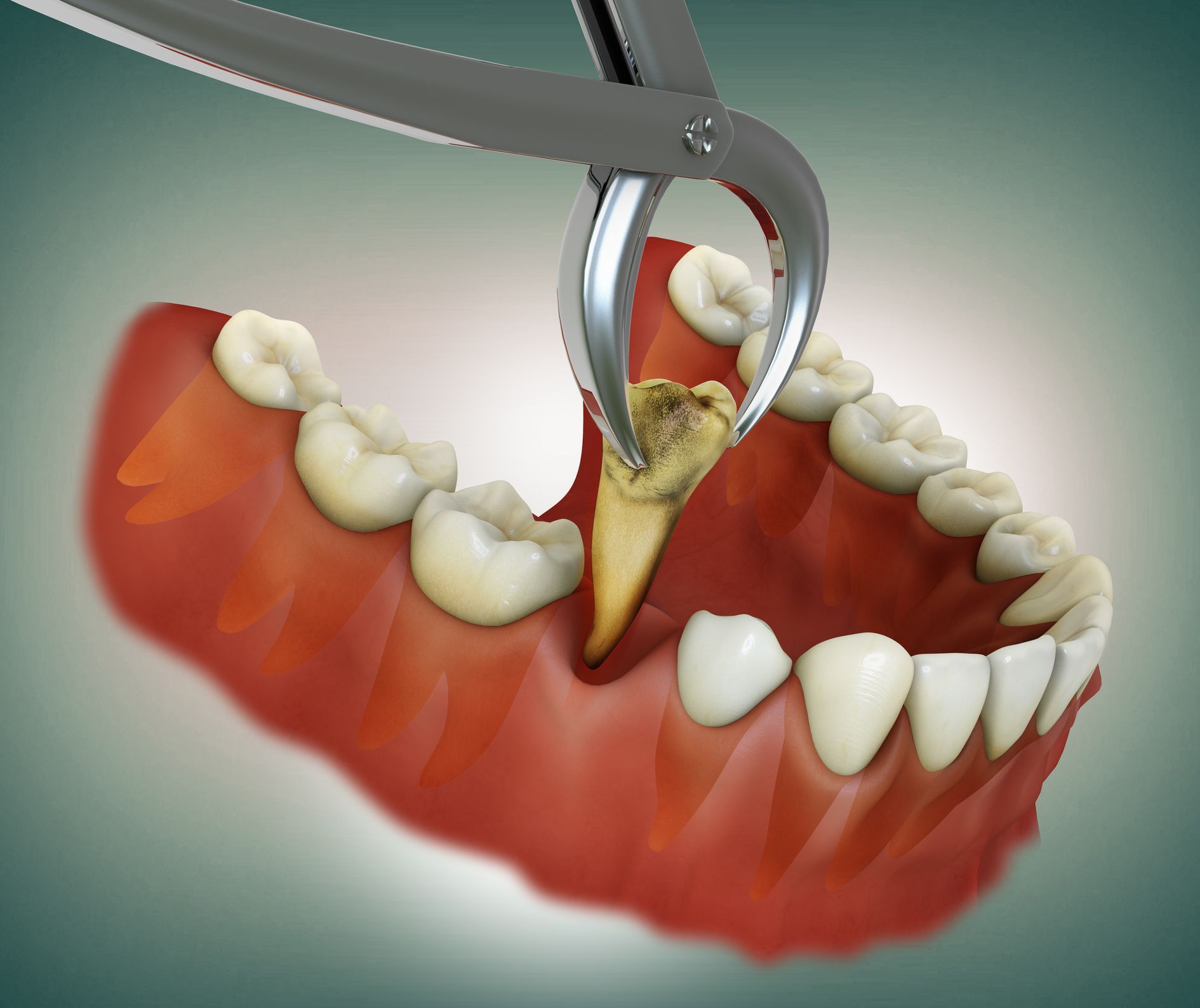 A tooth is being extracted with a pair of pliers