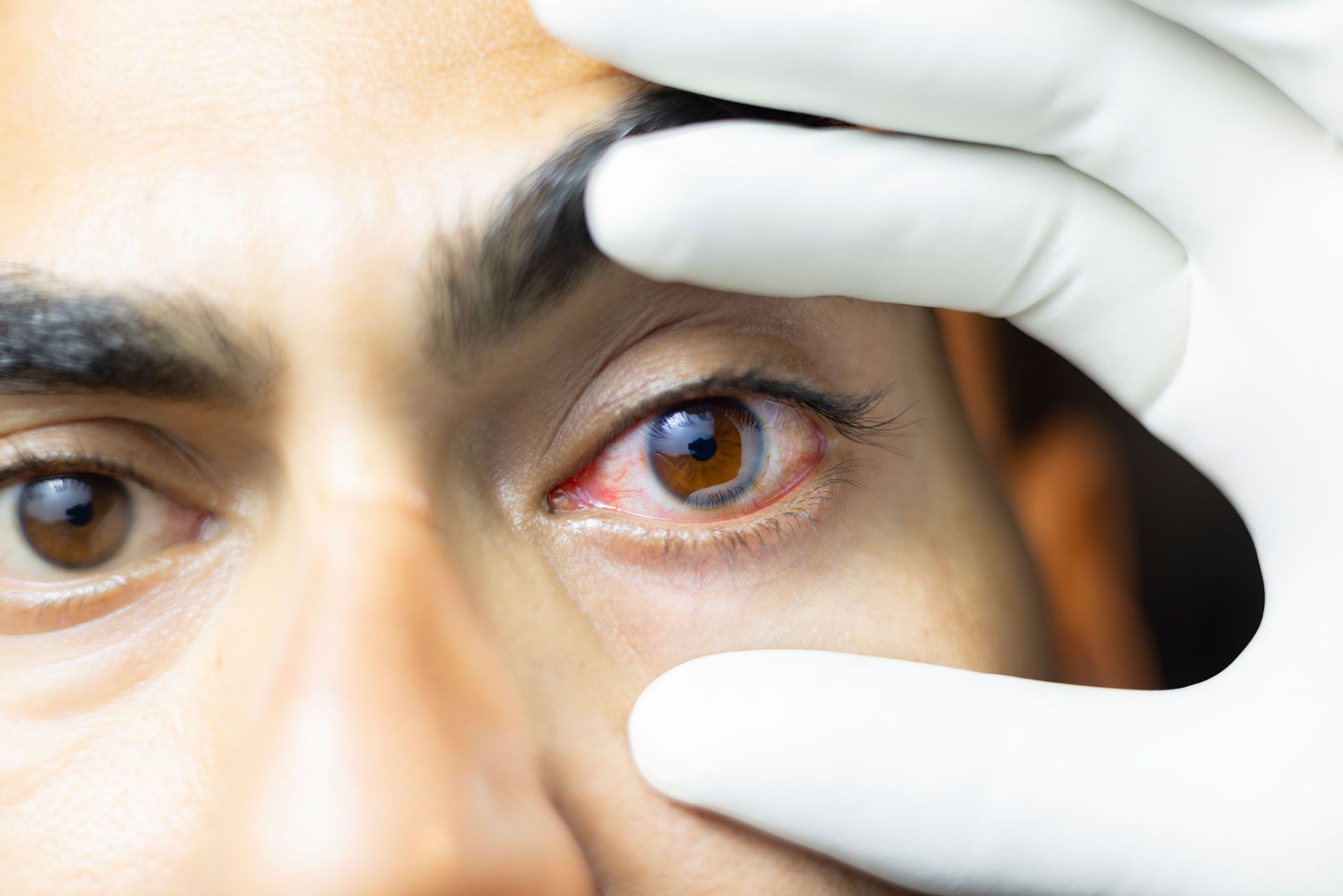 Eye infections — Latrobe, PA — Vittone Eye Associates PC