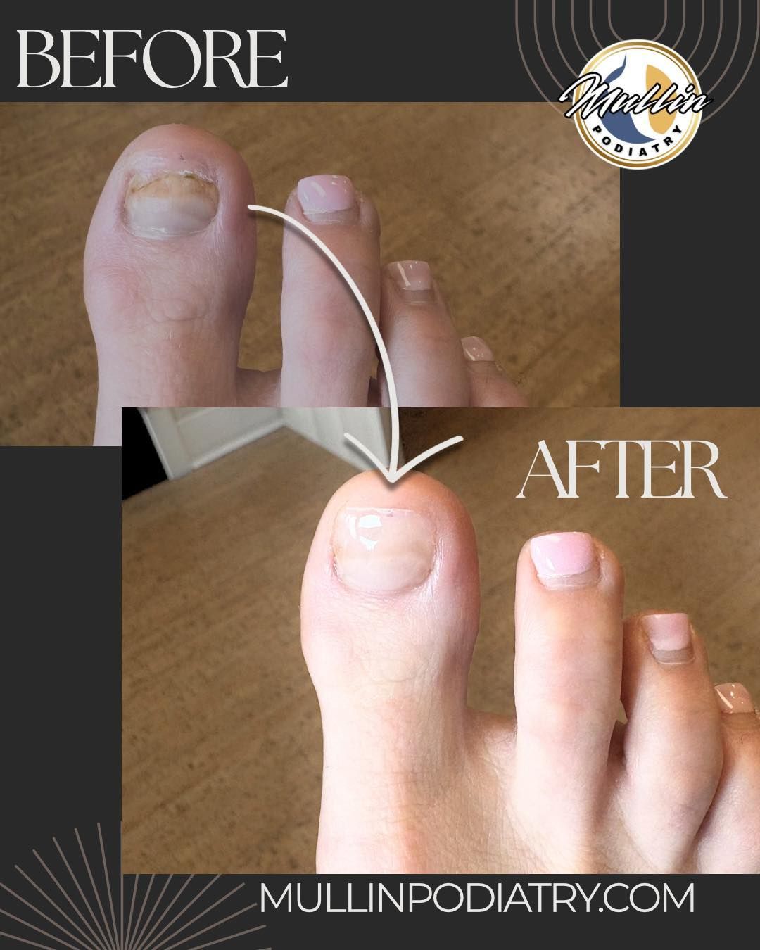 Before after image example using Keryflex by Mullin Podiatry