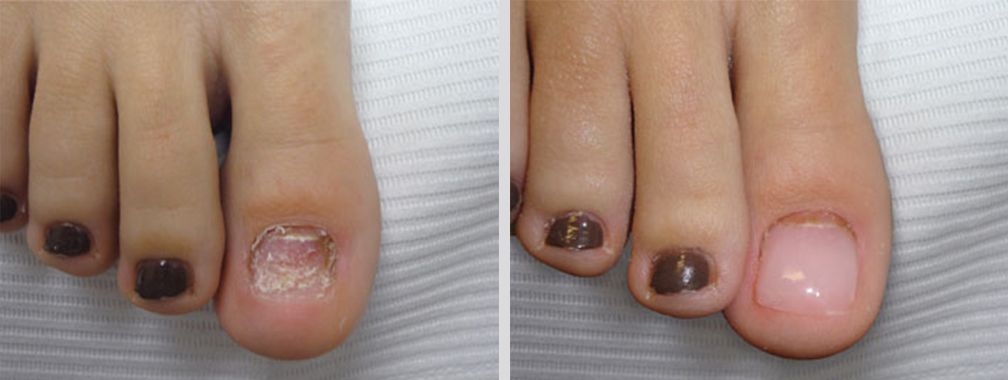 Before and after image using Keryflex product
Mullin Podiatry
