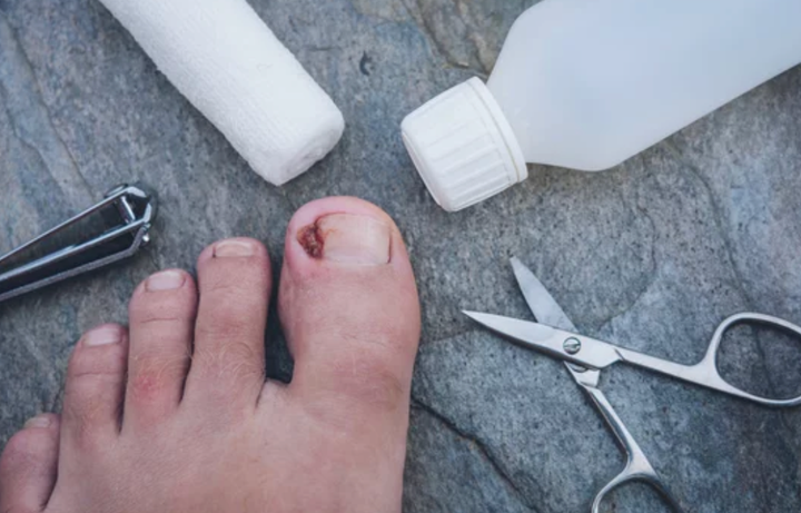 Ingrown toenail care