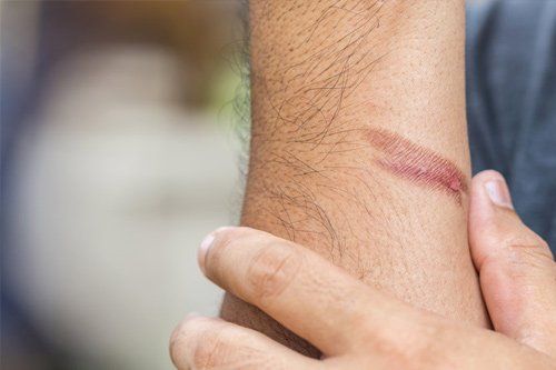 Stockton Burn Injury Attorney