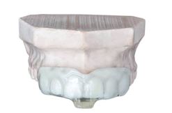 Custom Fitted Mouth Guards — Hobart, TAS — Moonah Dental Centre