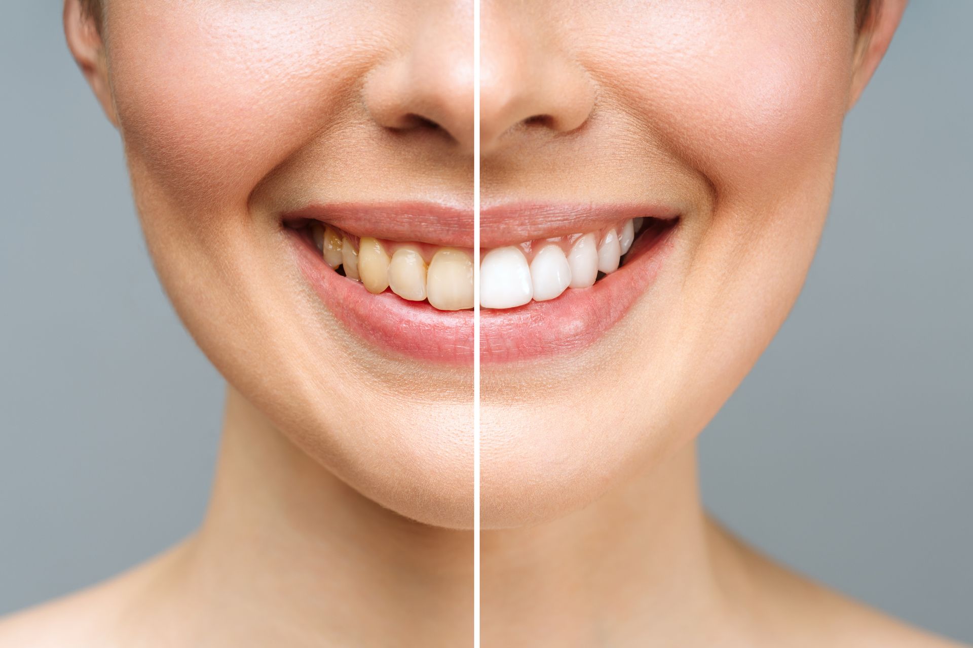 A woman's teeth before and after whitening.