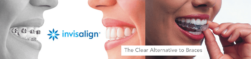 Clear Invisalign to Braces — Hobart, TAS — Moonah Dental Centre Clear Invisalign to Braces — Hobart, TAS — Moonah Dental Centre