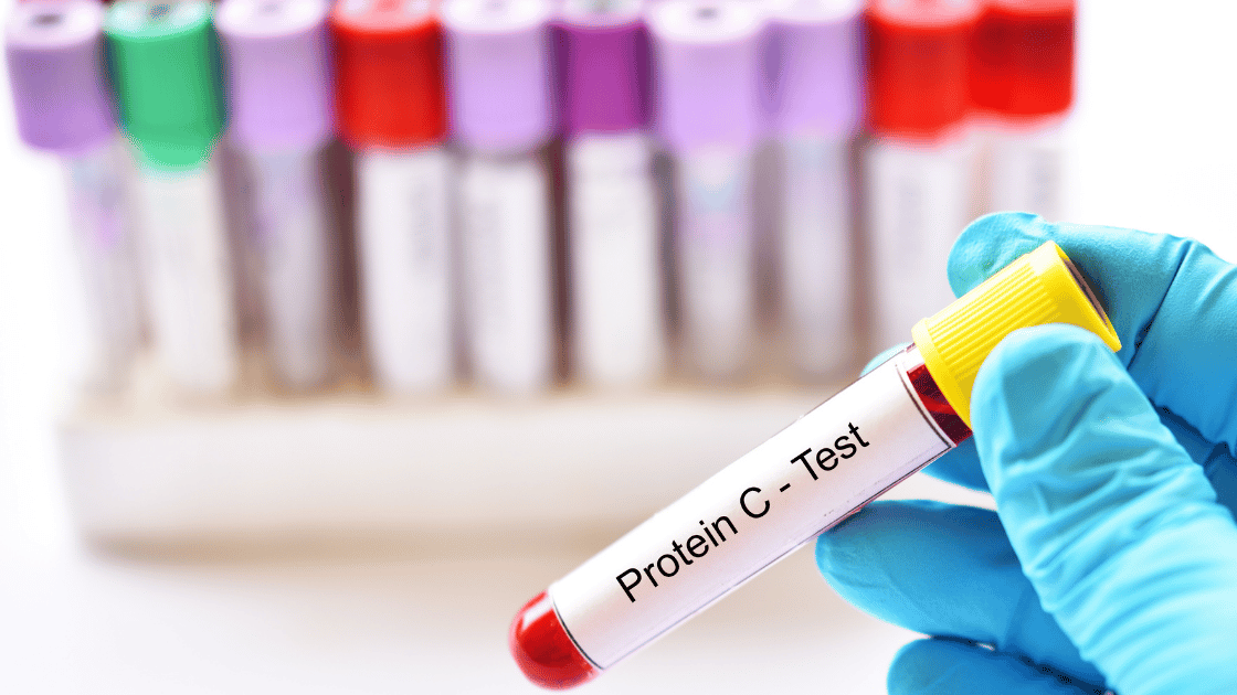 PCR nel sangue: scopri cos’è la proteina C reattiva, quando fare l’esame e come interpretare i valo