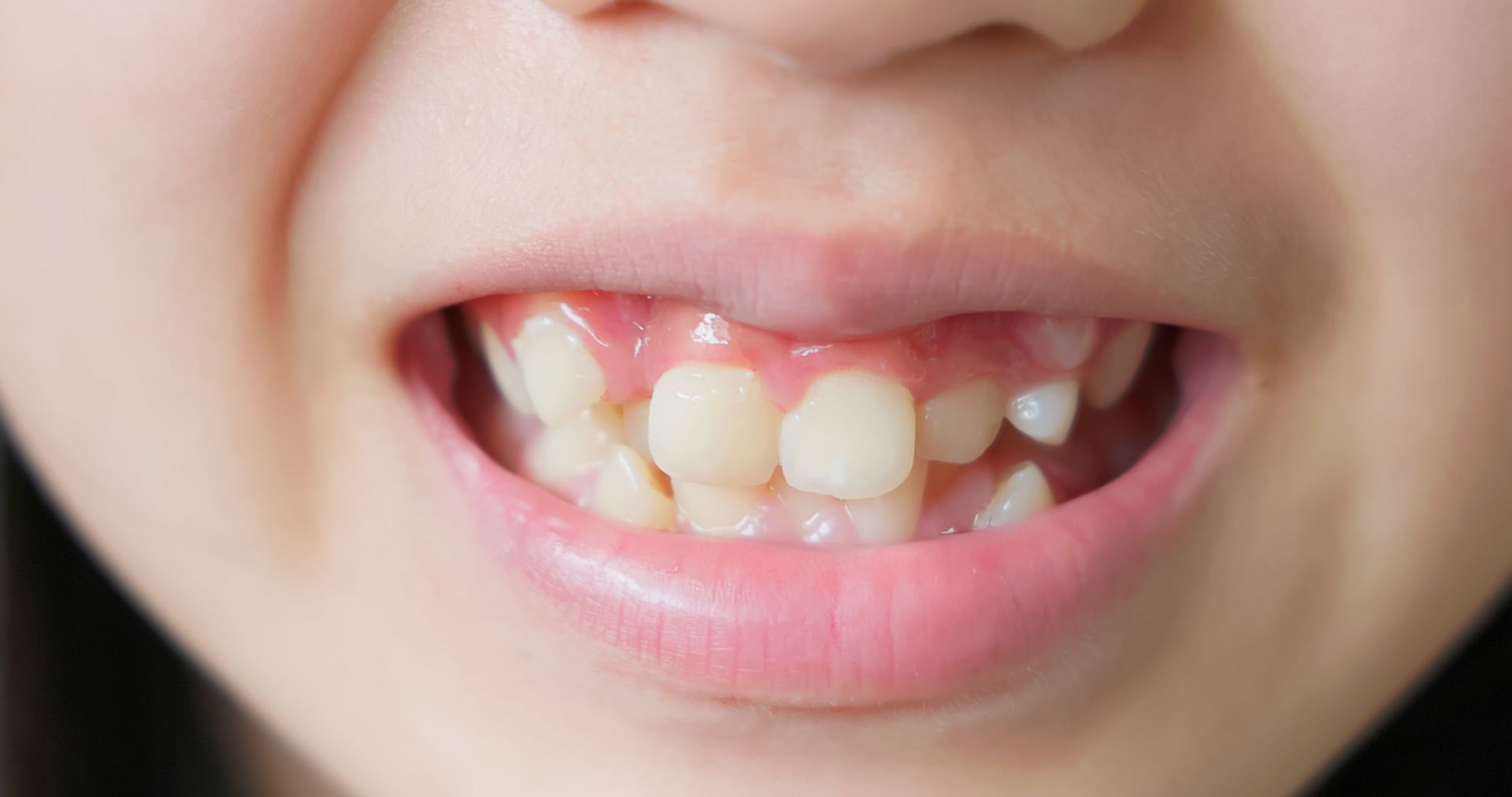 Close-up of a child's mouth showing missing front teeth and a playful smile