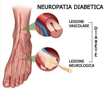 Un diagramma del piede di una persona con la parola diabetico su di esso