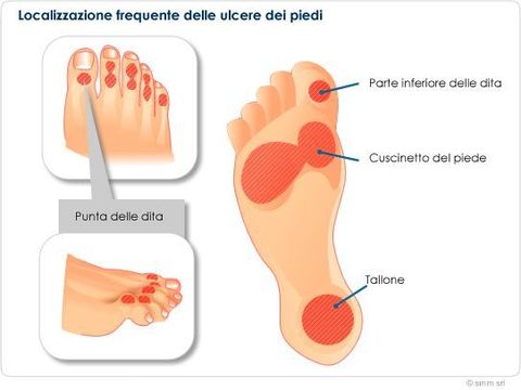 Un diagramma che mostra la posizione delle ulcere su un piede