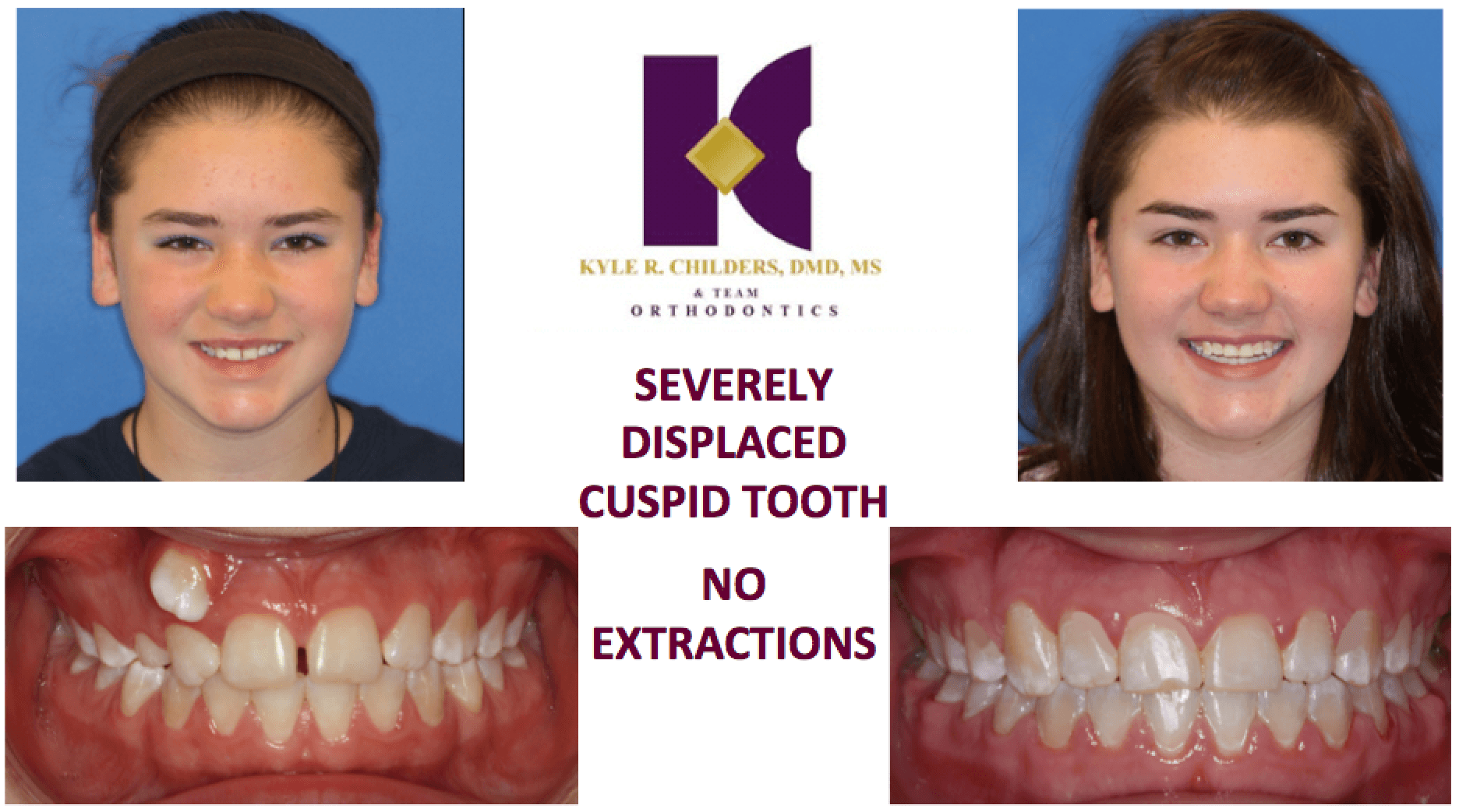A before and after picture of a girl 's teeth with the words 
